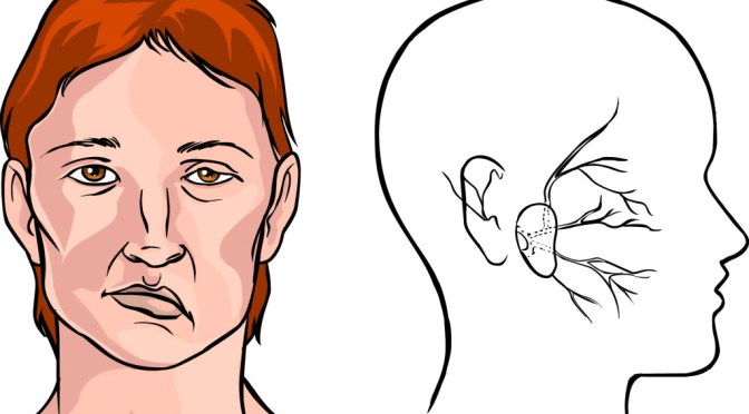 Mengenali Stroke dengan S-T-R
