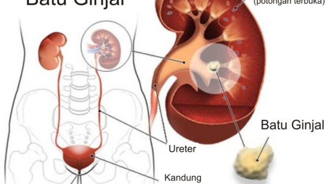 Apa Batu Ginjal (Nefrolithiasis) Itu?