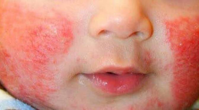 Mengatasi Eksim pada Kulit Anak