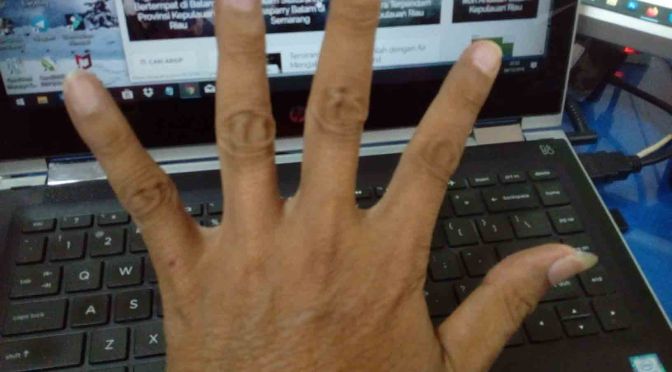 Cara Terhindar Melepuh Saat Tersiram Air Panas, Siramlah dengan Air Mengalir Biasa 3 – 5 Menit