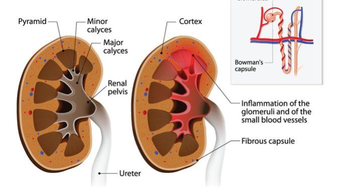 Inilah Penyebab (Pencetus) Gagal Ginjal yang Harus Diwaspadai